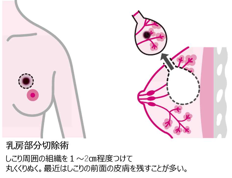 乳房部分切除術