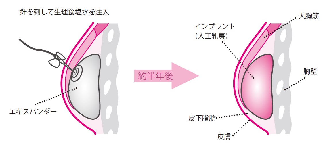 インプラントによる再建の手順